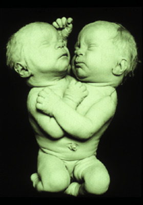 GC.10364
<br/>
Dicephalic, tetrabrachial conjoined twins
<br/>
<em></em>